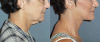 55-64 year old woman treated with Facelift with Neck Lift