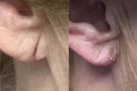 55-64 year old woman treated with Earlobe Surgery