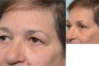 64 year old woman treated with Eyelid Surgery