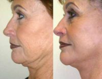 64 year old woman treated with Neck Lift