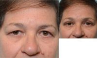 64 year old woman treated with Eyelid Surgery for vision loss