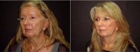 64 Year Old Woman Treated With Facelift Before By Dr. Dominic Castellano, MD, Tampa Facial Plastic Surgeon