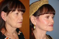 65 year old female desiring facial rejuvenation