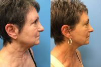 65-74 year old woman treated with Facelift and Neck Lift