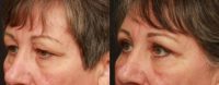65 year old woman treated with Eyelid Surgery