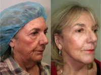 65-74 year old woman treated with Facelift and Brow Lift