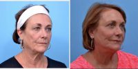 65 Year Old Woman Treated With Facelift Before By Dr P. Daniel Ward, MD, Salt Lake City Facial Plastic Surgeon