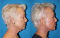67 year old woman treated with Facelift