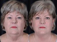 68 year old woman treated with Facelift
