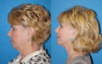 68 year old woman treated with Facelift