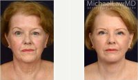68 Year Old Woman Treated With Facelift Before By Dr. Michael Law, MD, Raleigh-Durham Plastic Surgeon