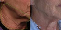 65-74 year old woman treated with Botox