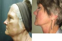 65-74 year old woman treated with Face/neck lift, CO2 laser resurfacing, upper eyelid surgery