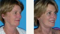 69 Year Old Woman Treated With Facelift Before With Doctor Alyson Wells, MD, FACS, Baltimore Plastic Surgeon