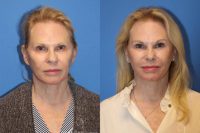 65-74 year old woman treated with Facelift