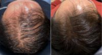 65-74 year old man treated with Hair Loss Treatment