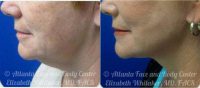 72 Year Old Woman Treated With Facelift Before By Doctor Elizabeth Whitaker, MD, FACS, Atlanta Facial Plastic Surgeon