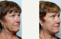 72 Year Old Woman Treated With Facelift Before With Dr. Babar Sultan, MD, Baltimore Facial Plastic Surgeon
