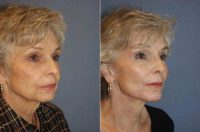 72uo patient, Endoscopic Composite Facelift , Endoscopic Browlift  and Laser to eyes and mouth