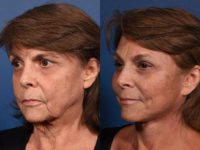 65-74 year old woman treated with Deep Plane Facelift