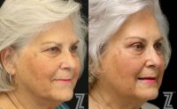 65-74 year old woman treated with Brow Lift and an Upper Eyelid Surgery