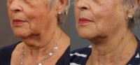 75 and up year old woman treated with Direct Anterior Neck Lift