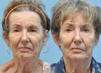 75 year old woman with synkinesis after Bell's palsy