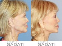 76 year old woman treated with Facelift Revision in Orange County