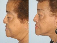 77 year old woman treated with Facelift