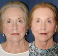 77 year old woman treated with Facelift