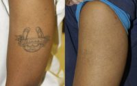 African American Tattoo Removal