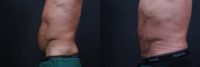 Athletic male who benefited from endoscopic lower abdominal wall tightening.