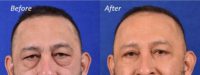 Before and after upper and lower eyelid rejuvenation