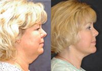 Facelift and browlift