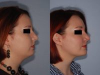 Chin Augmentation and Smartlipo neck