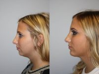 Chin Implant and Rhinoplasty revision, 25 year old female