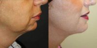 Chin implant + Facelift