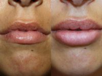 Dermal Lip Graft (Lip Augmentation)