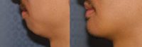 25-34 year old man treated with Chin Implant