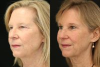 65-74 year old woman treated with Brow Lift and an Upper Eyelid Surgery