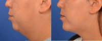 Chin Implant, submental liposuction and buccal fat removal