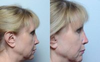 55-64 year old woman treated with Juvederm for liquid Rhinoplasty