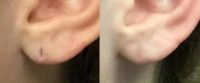 18-24 year old woman treated with Earlobe Surgery