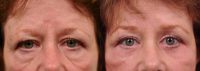 65 year old lady who underwent lower eyelid surgery and Botox.