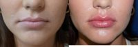 18-24 year old woman treated with Restylane Defyne