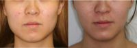 25-34 year old woman treated with Botox to the masseters to thin the face