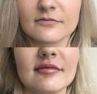 25-34 year old woman treated with Lip Augmentation