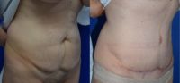 45-54 year old woman treated with BodyTite of Abdomen and Flanks