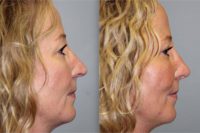 Rhinoplasty to improve profile as well as to deproject and rotate tip