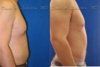 18-24 year old man treated with Liposuction